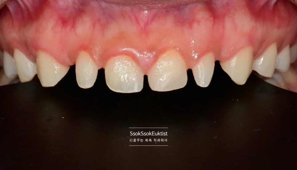 라미네이트 준비 실 삽입 과정