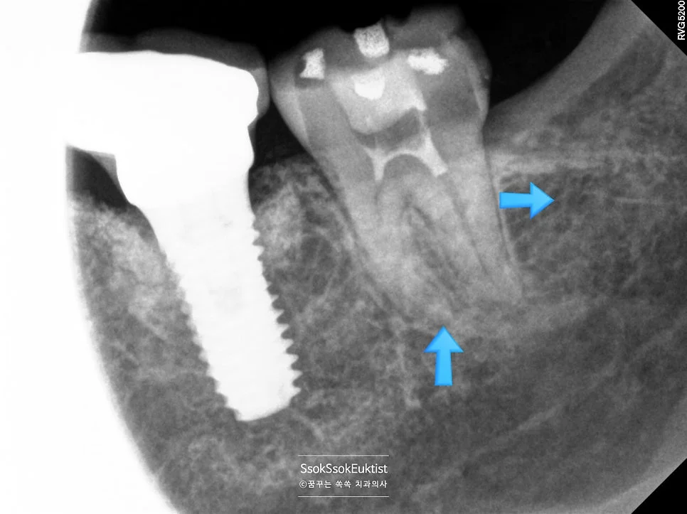 왼쪽 사랑니 발치 완료 1