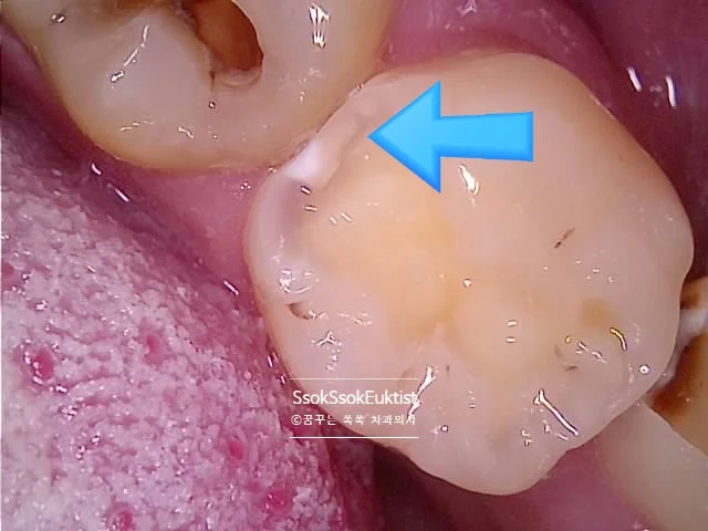 왼쪽 아래 6번 치아 사이 충치