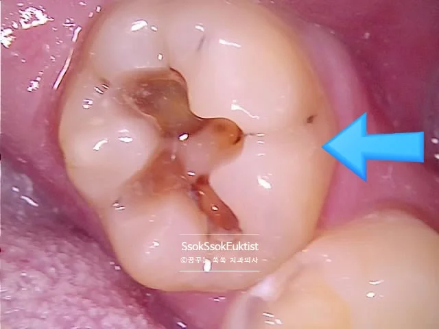 왼쪽 아래 7번 치아 깊은 충치
