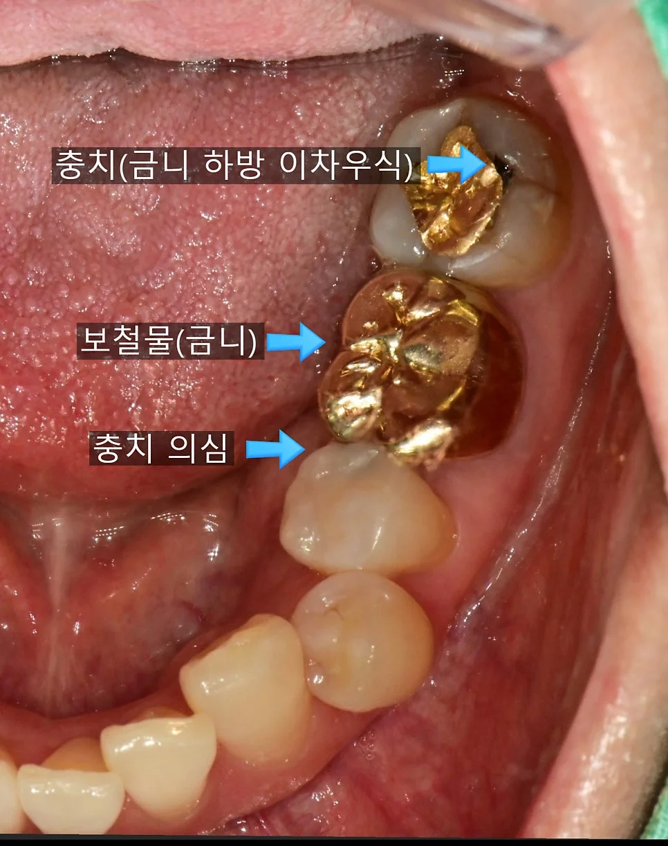 왼쪽 아래 금니 크라운 주변 충치 의심 임상 사진