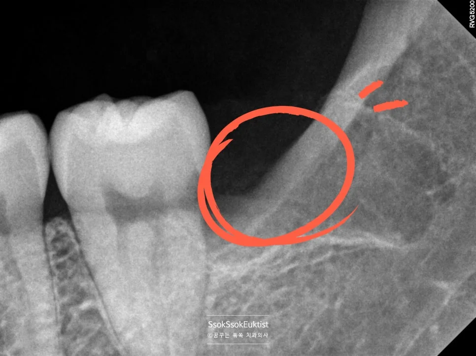 왼쪽 아래 매복 사랑니 발치 후 방사선