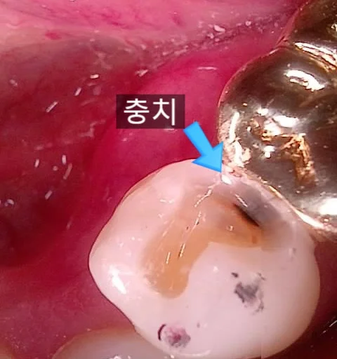 왼쪽 아래 작은 어금니 충치 진단 사진