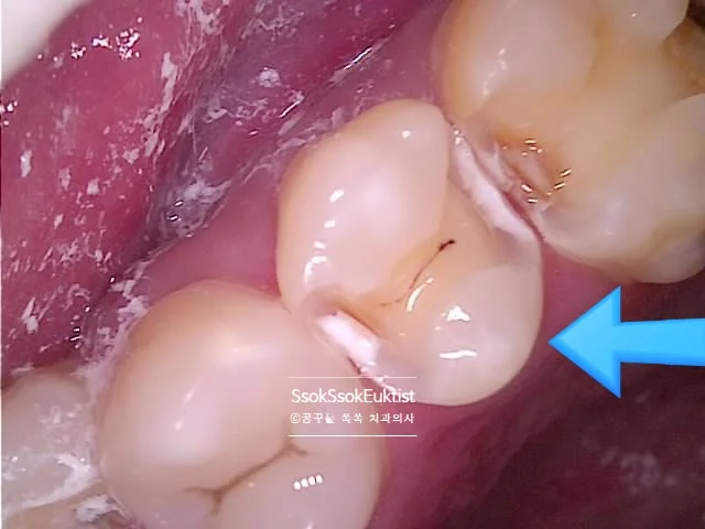 왼쪽 위 5번 치아 양쪽 충치