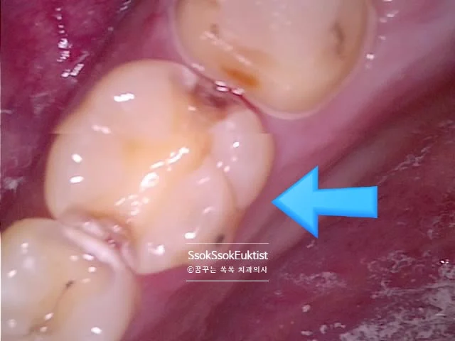 왼쪽 위 6번 치아 양쪽 충치