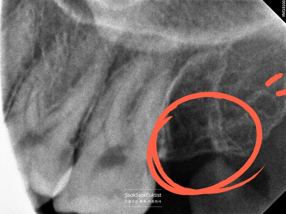 왼쪽 위 사랑니 발치 후 방사선
