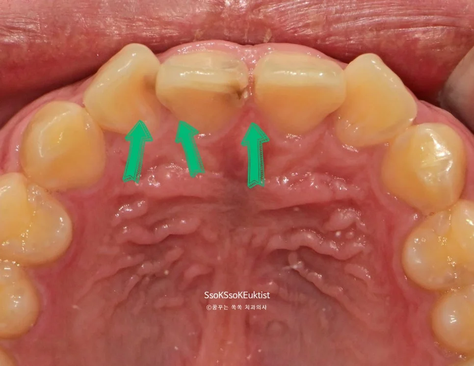 치아 안쪽 설측 충치 부위 근접 확인