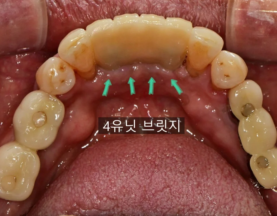 아래 앞니 임플란트 브릿지 시술 후 설측 교합면