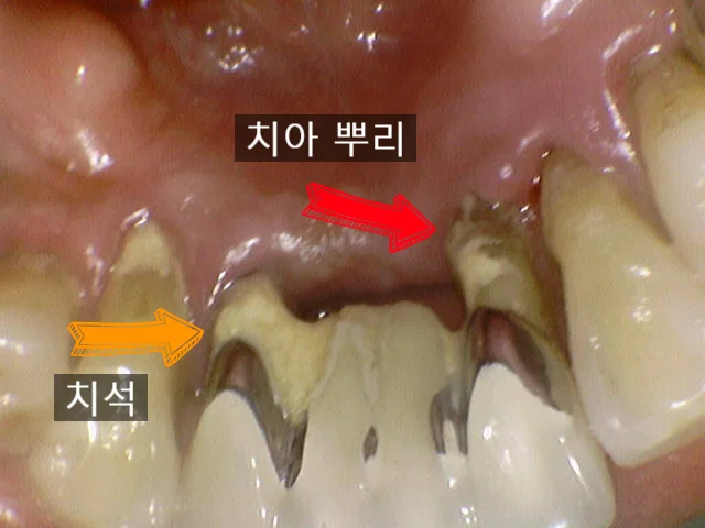 아래 앞니 시술 전 구내사진 심한 치석 뿌리 노출