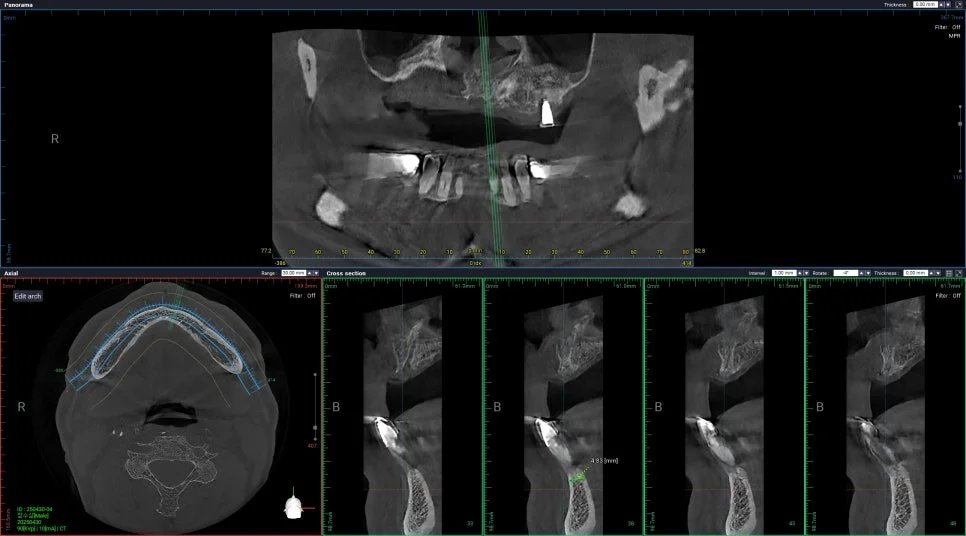 아래 앞니 CBCT 3차원 임플란트 식립 계획