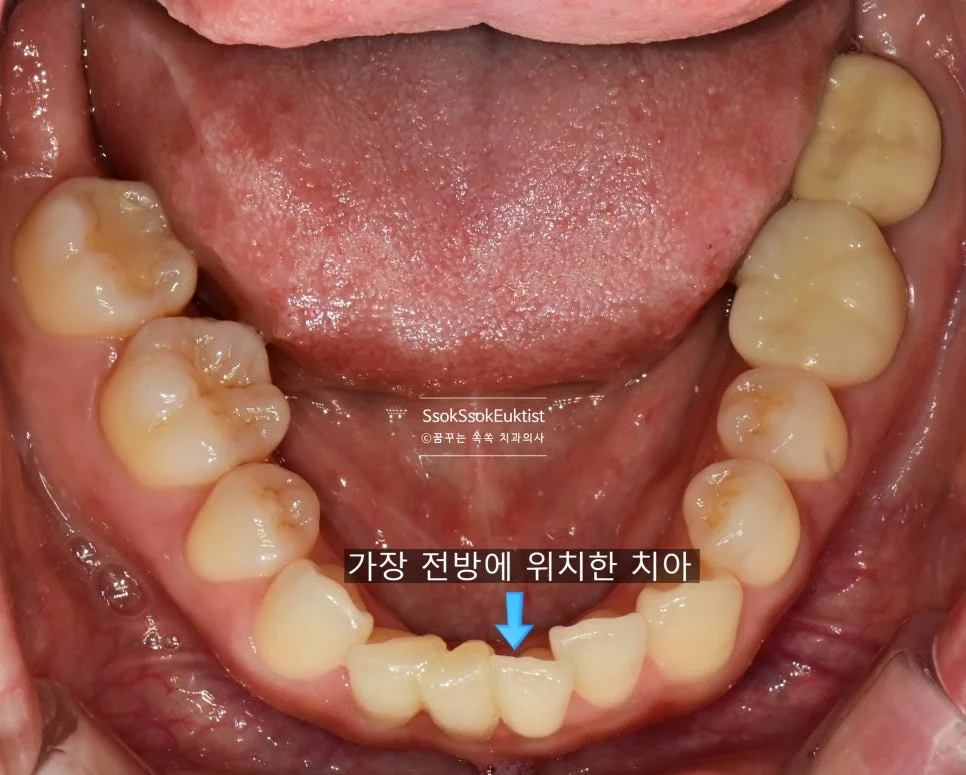 하악 앞니 교합면 사진 크라우딩 상태 가장 전방에 위치한 치아 화살표 표시