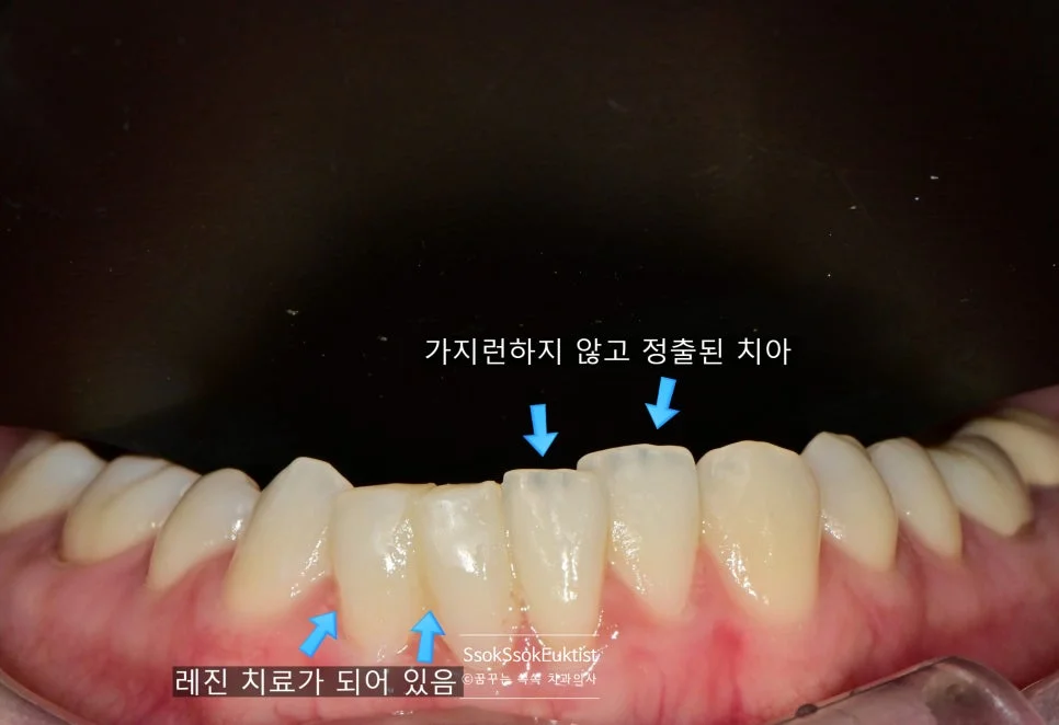 아래 앞니 치료 전 진단 사진 가지런하지 않고 정출된 치아와 레진 치료 부위 화살표 표시