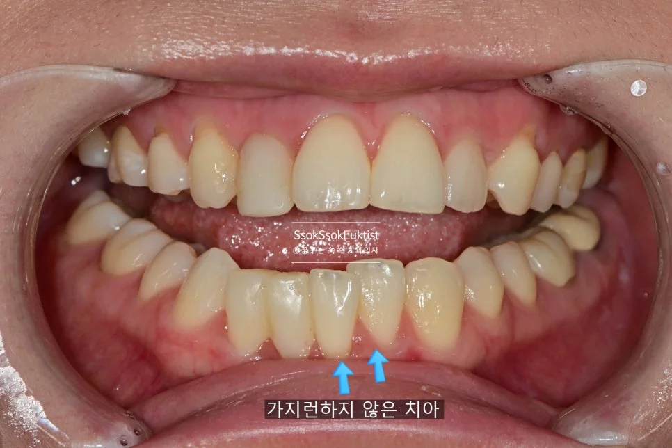 아래 앞니 크라운 치료 전 가지런하지 않은 치아 화살표 표시 정면 교합 사진