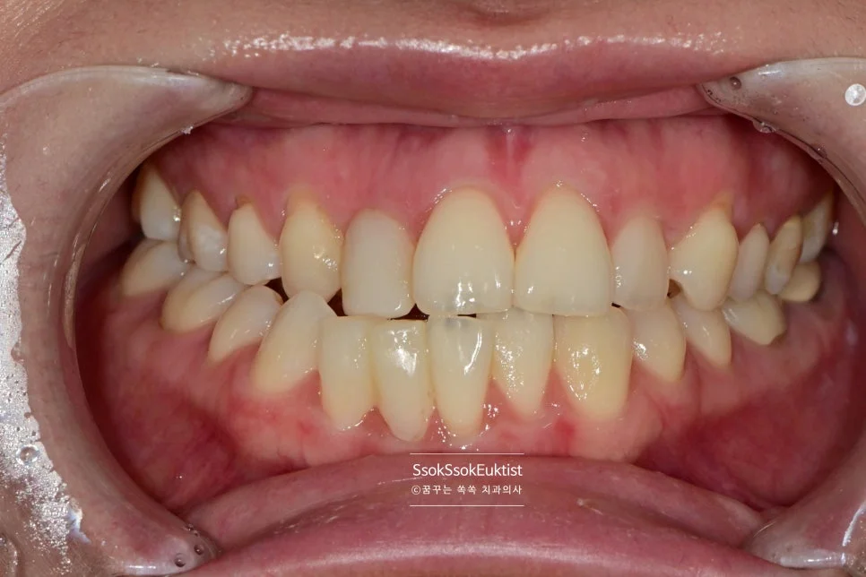 아래 앞니 크라운 치료 전 정면 교합 사진 가지런하지 않은 치아 배열