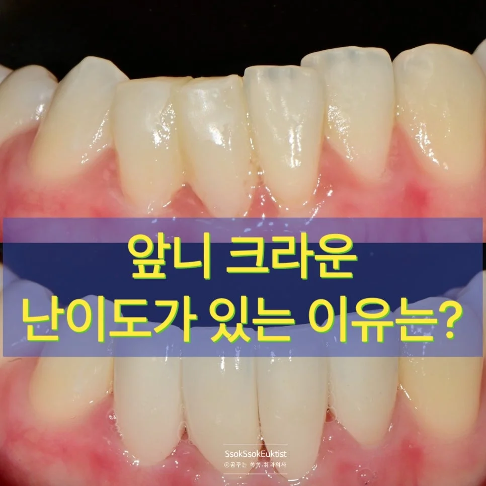 아래 앞니 4개 크라운 완성 모습 앞니 크라운 난이도 소개