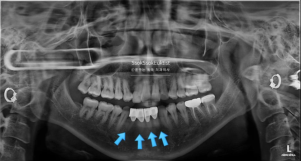 아래 앞니 4개 크라운 파노라마 X-ray 화살표 표시