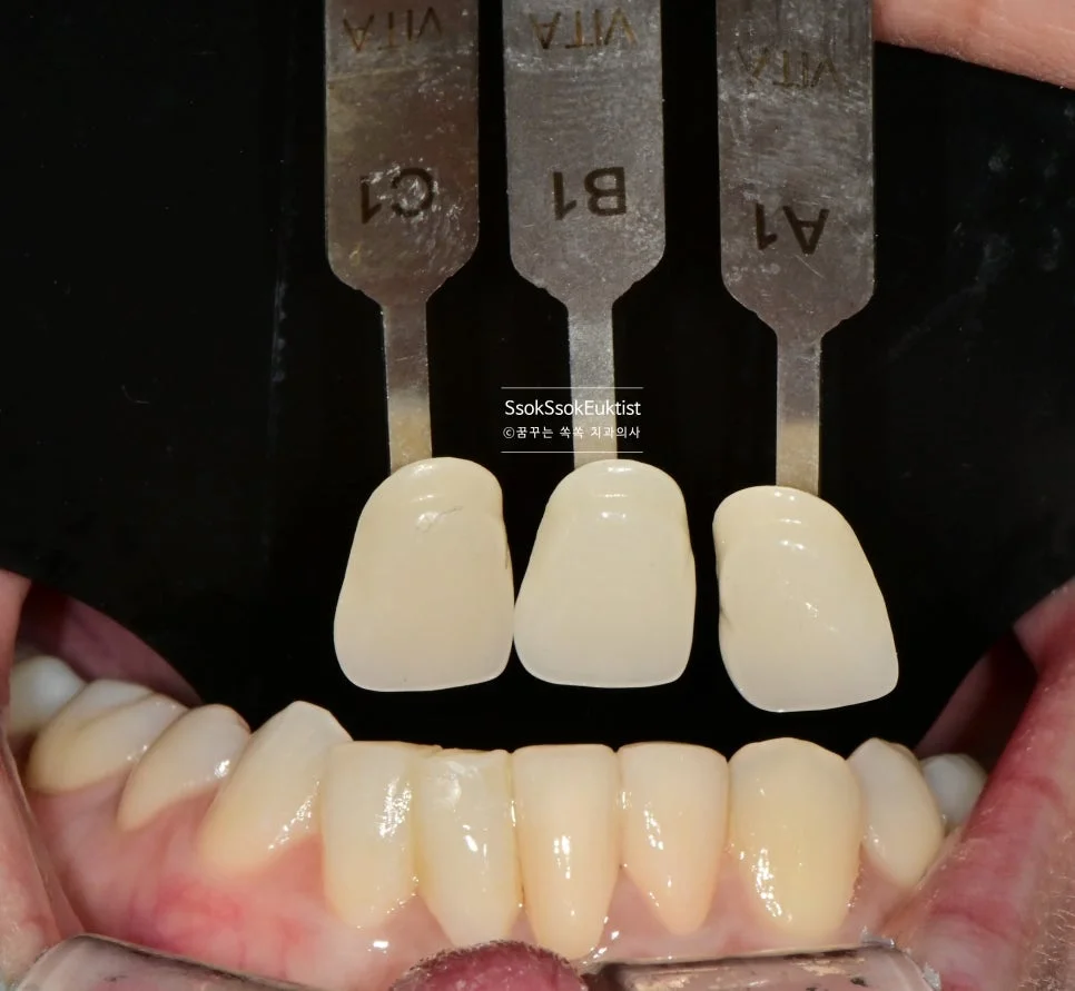 앞니 크라운 쉐이드 가이드 색상 비색 과정 VITA A1 B1 C1