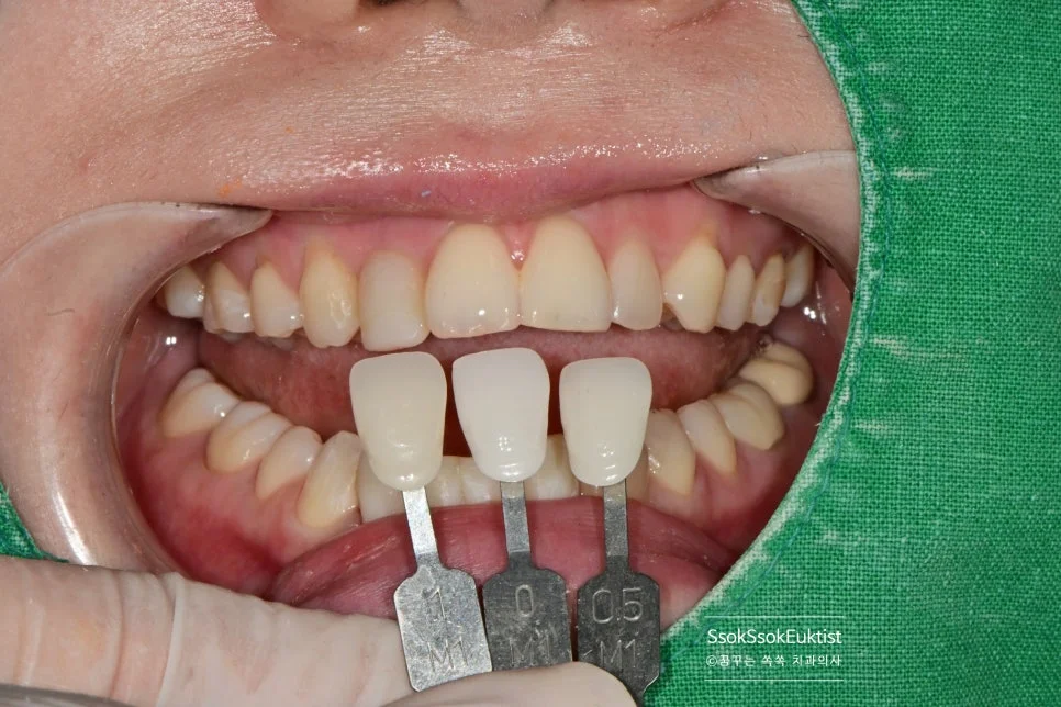 앞니 크라운 2차 쉐이드 가이드 비색 4개 크라운 색상 통일 과정