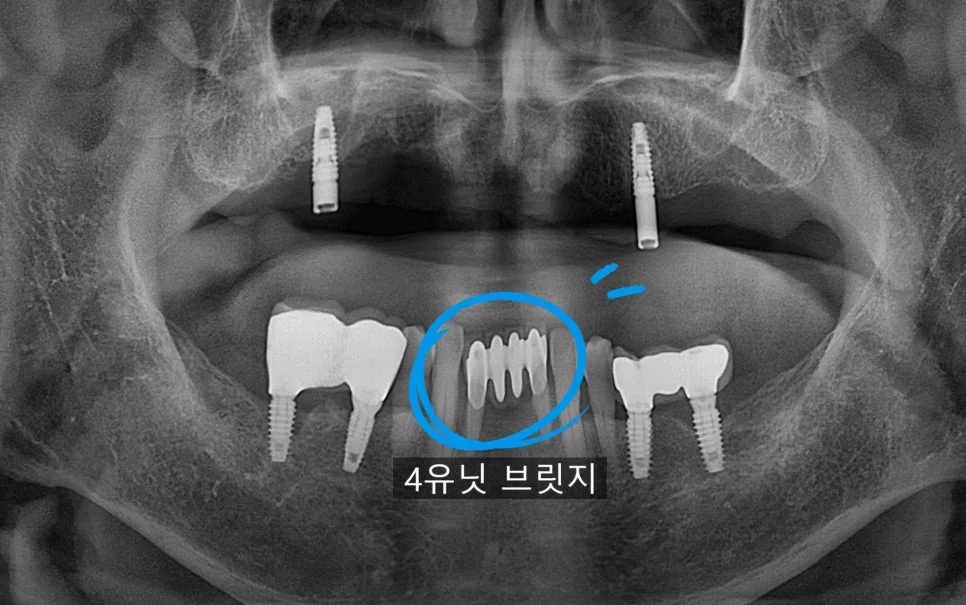 아래 앞니 흔들림 진단 파노라마 X-ray 하악 전치부