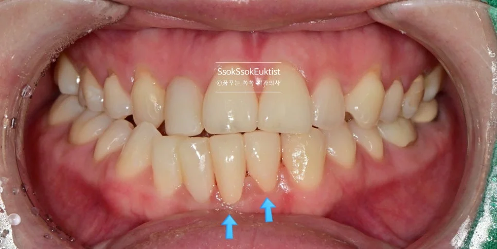 아래 앞니 2개 크라운 치료 완료 정면 사진 화살표 표시