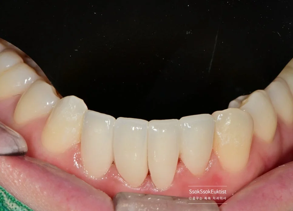 아래 앞니 4개 크라운 최종 결과 가지런하고 심미적인 치아