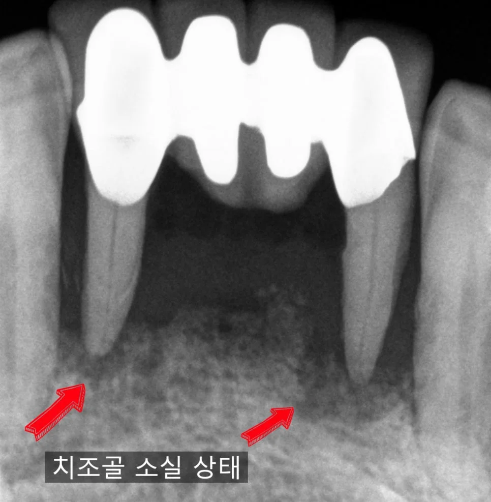 아래 앞니 치근단 X-ray 심한 치조골 소실