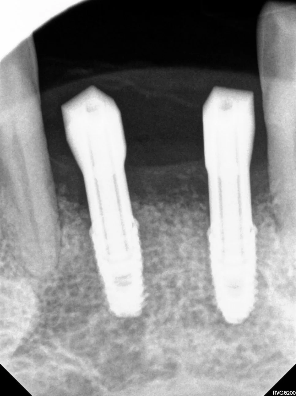 아래 앞니 임플란트 골유착 확인 치근단 X-ray