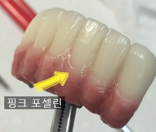 아래 앞니 핑크 포셀린 4유닛 임플란트 브릿지 보철물
