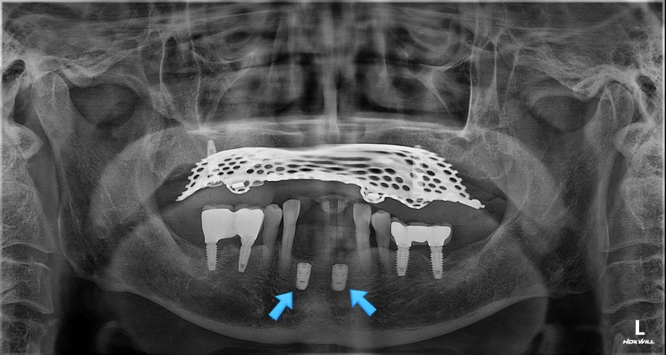 아래 앞니 임플란트 2개 식립 후 파노라마 X-ray