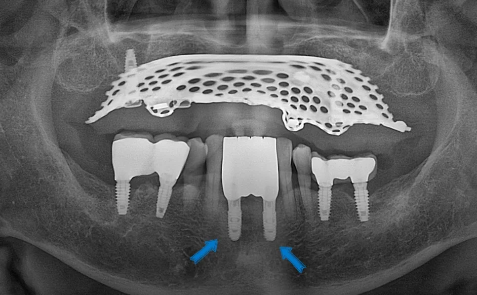 아래 앞니 임플란트 브릿지 장착 결과 파노라마 X-ray
