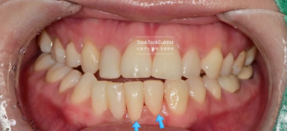 아래 앞니 2개 크라운 장착 전 정면 교합 사진 화살표 표시