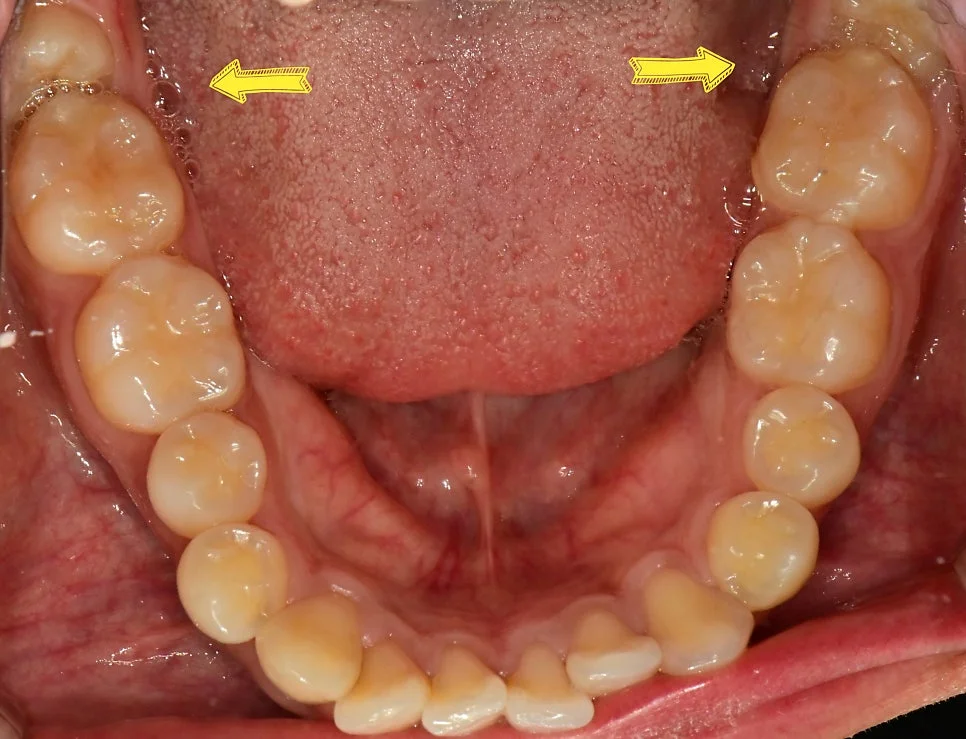하악 교합면 사진 양측 사랑니 화살표 표시