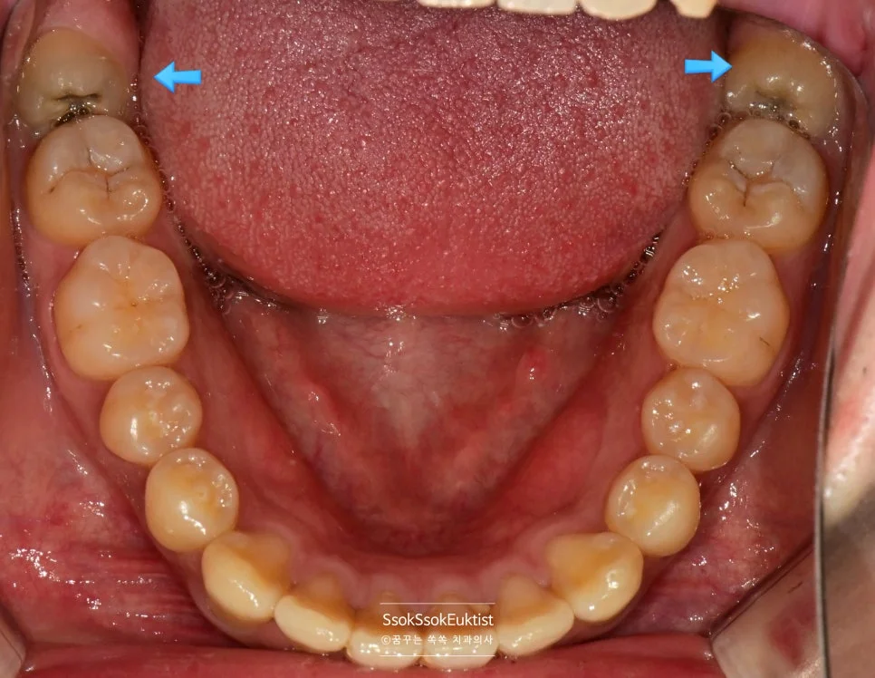 하악 구강 사진 매복 사랑니