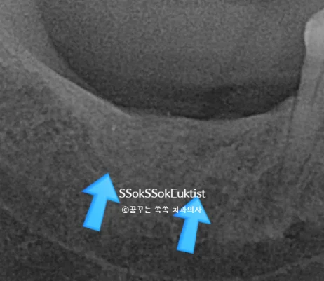 하악 임플란트 식립 가능 부위 방사선