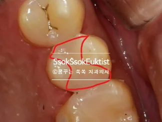 MOD 인레이 설명 이미지
