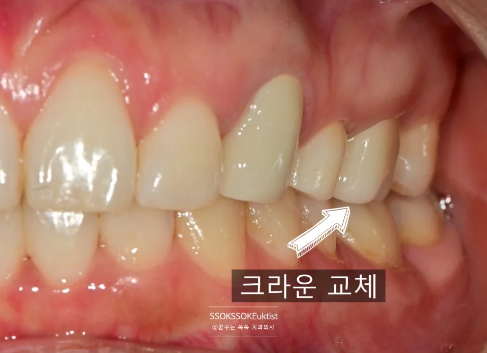 새 도재 크라운 교체 완료 자연스러운 마무리