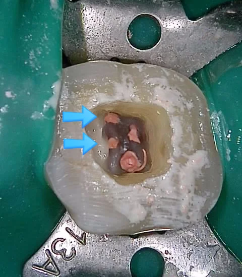근관충전 완료 X-ray - 치근 끝까지 긴밀 충전