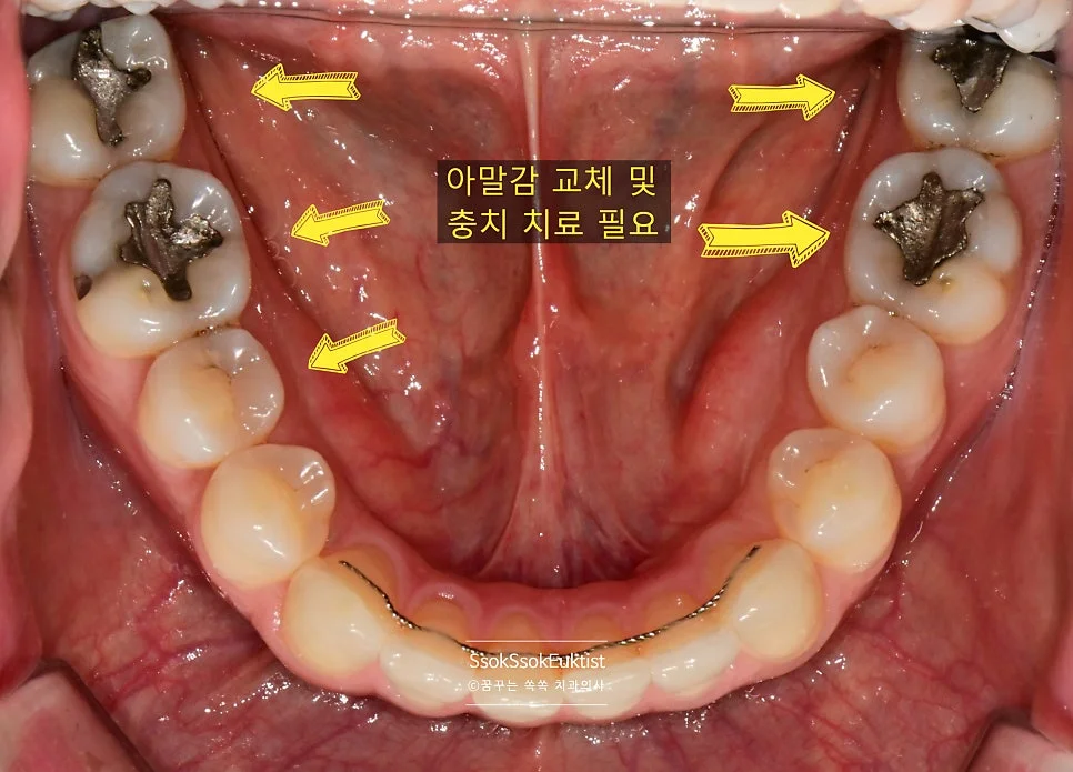 후방 어금니 부위 오래된 아말감 충전물 교체 전 임상사진