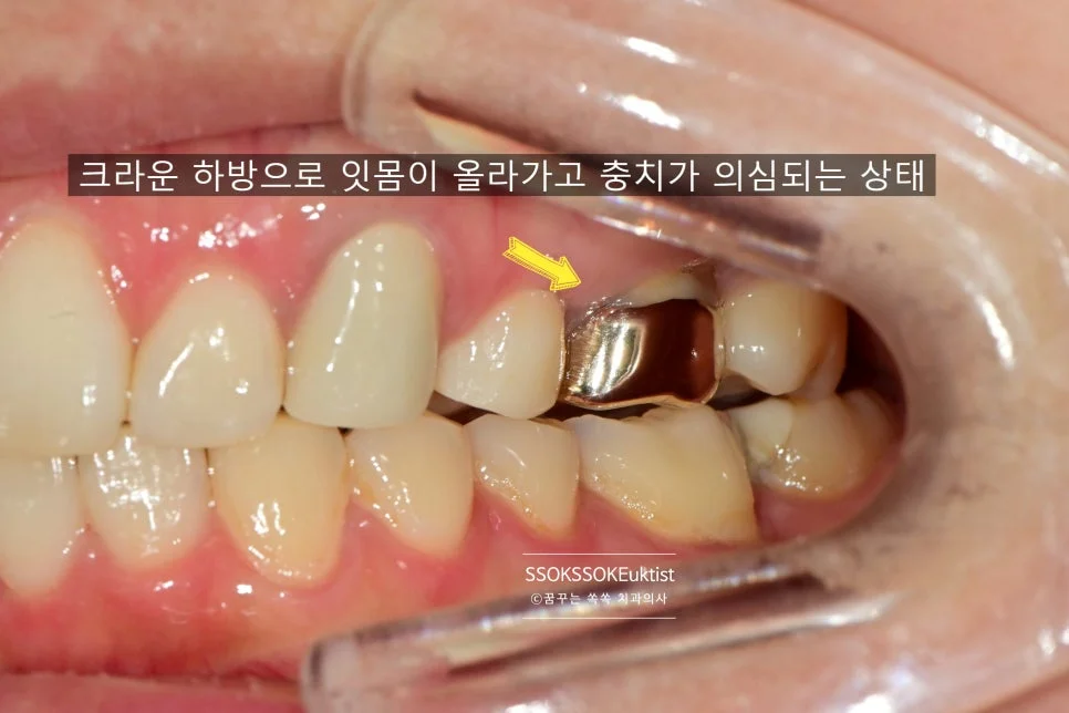 오래된 크라운 잇몸 내려감 충치 의심 치료 전