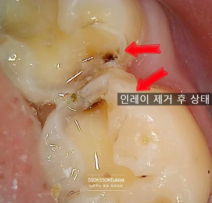 오래된 인레이 제거 후 이차 충치 확인