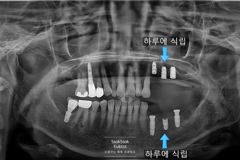 원데이 수술 상악동 거상술 뼈이식 녹는 실 봉합 사진