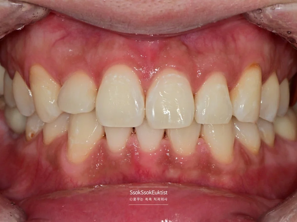 원데이 미백 증례1 시술 후 A1보다 밝아진 치아