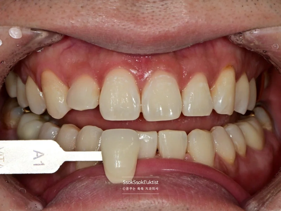 원데이 미백 증례1 시술 후 쉐이드 가이드 A1 비교