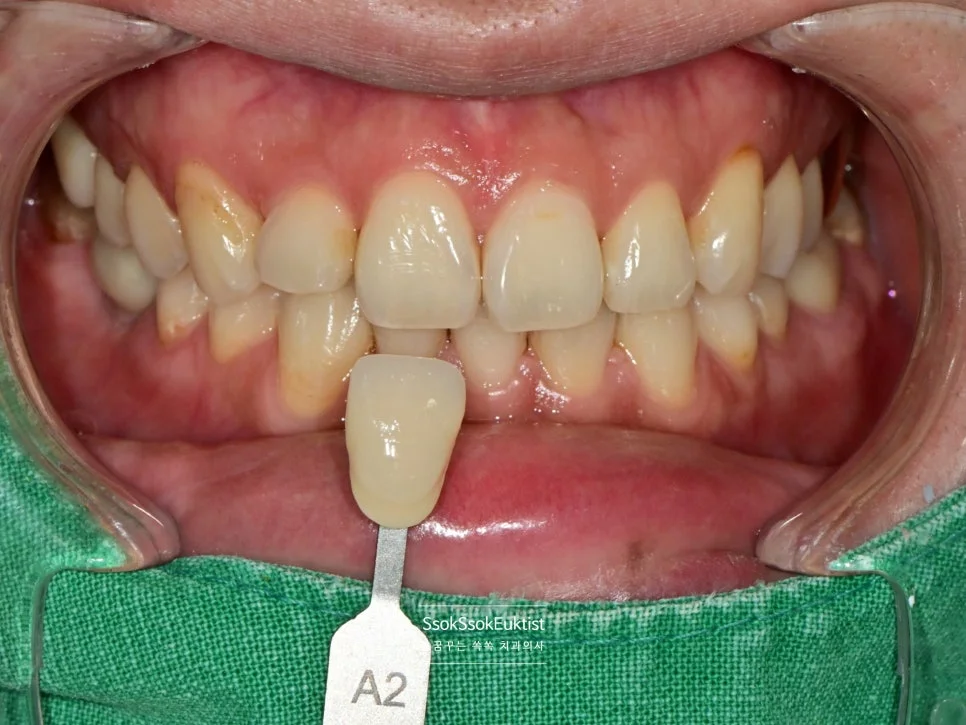 원데이 미백 증례1 시술 전 쉐이드 가이드 A2 비교