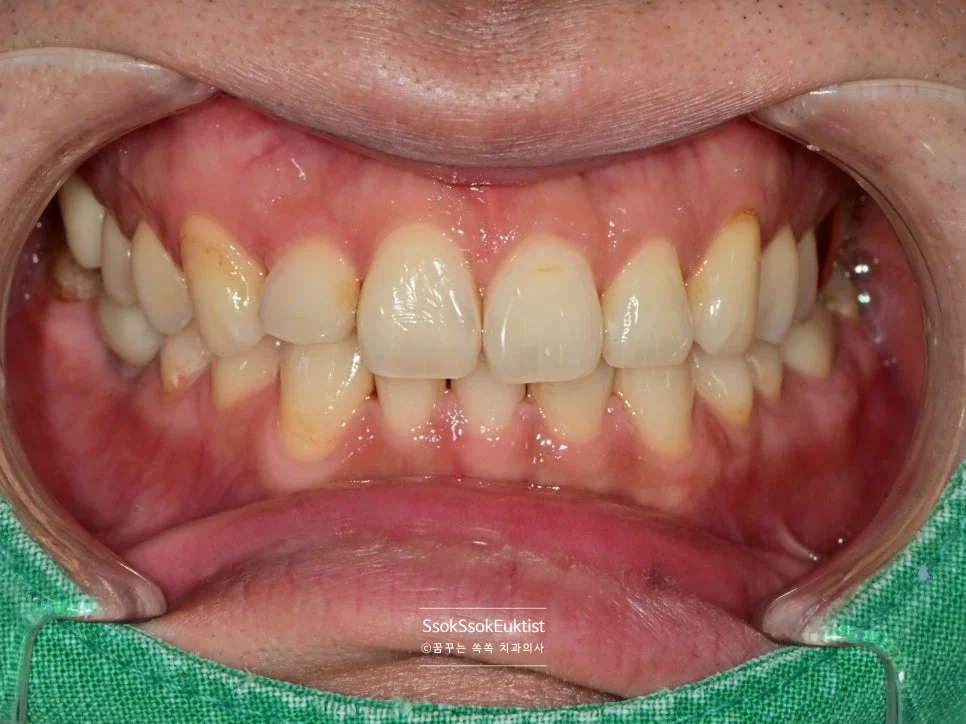 원데이 미백 증례1 시술 전 상악 전치부 A2 쉐이드