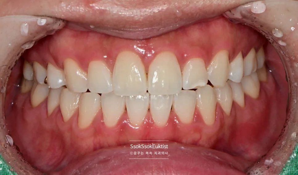 원데이 미백 증례2 시술 후 B1보다 밝아진 치아