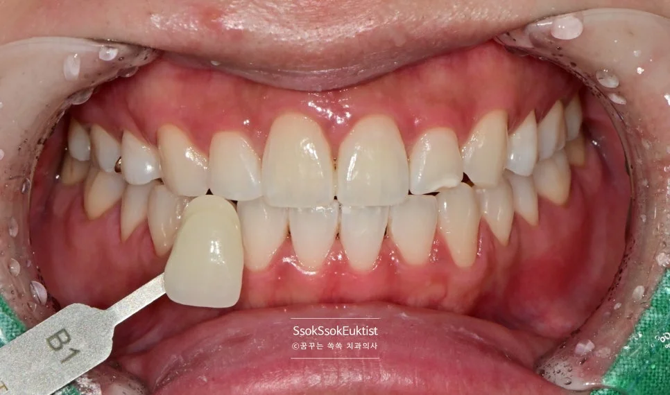 원데이 미백 증례2 시술 후 상악 전치부 상세