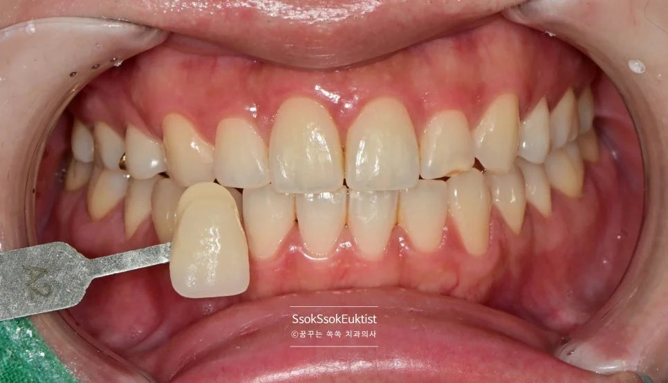 원데이 미백 증례2 시술 전 쉐이드 가이드 A2 비교