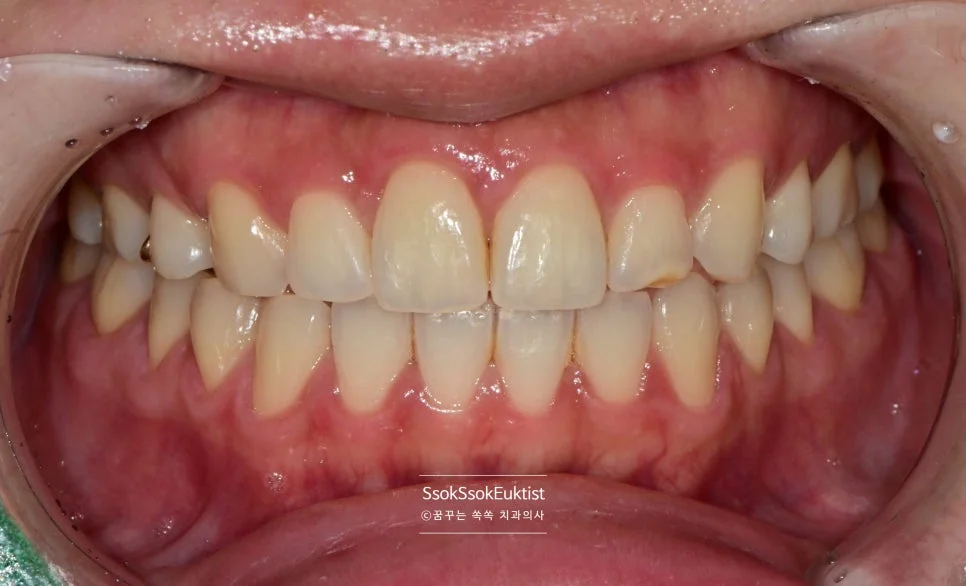 원데이 미백 증례2 시술 전 상악 전치부 A2 쉐이드