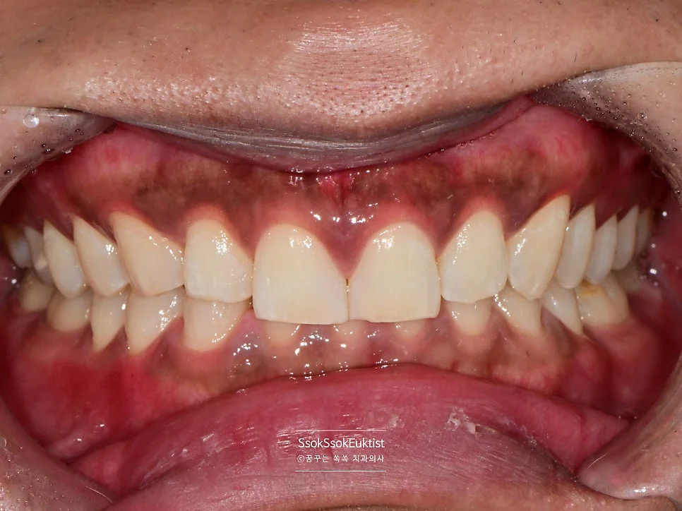 원데이 미백 증례3 시술 후 A1보다 밝아진 치아